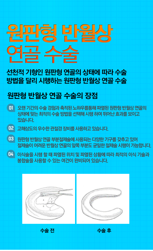 전방십자인대 재건술
