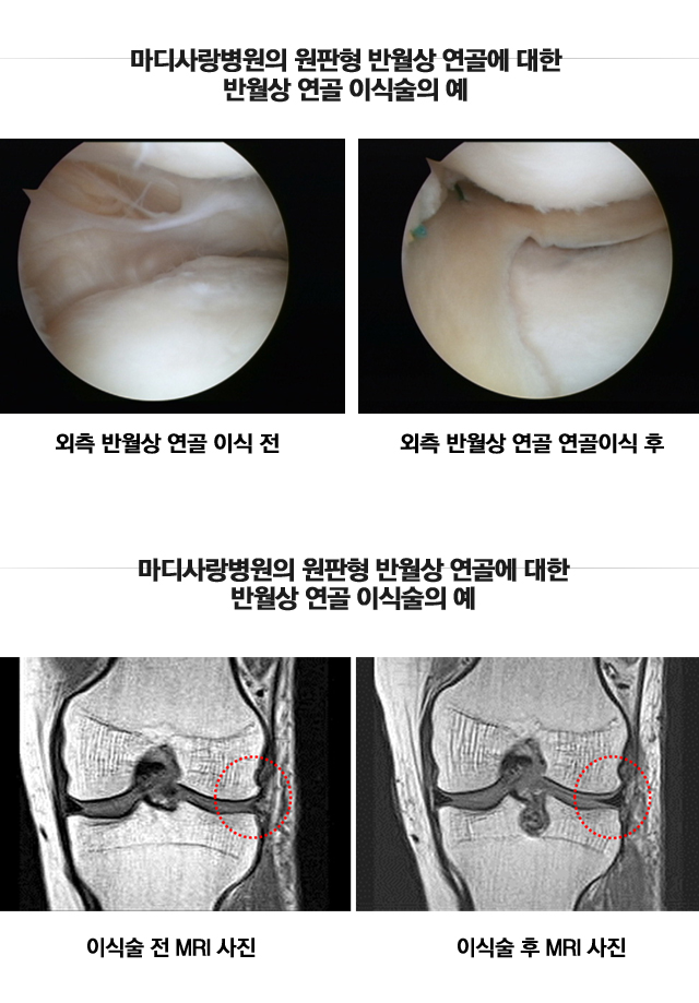 전방십자인대 재건술