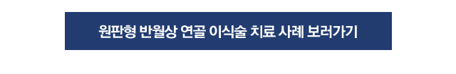 전방십자인대 재건술