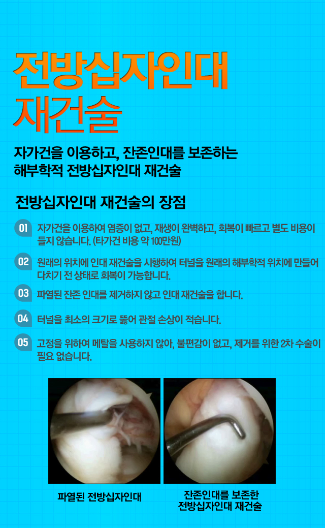 후방십자인대 재건술
