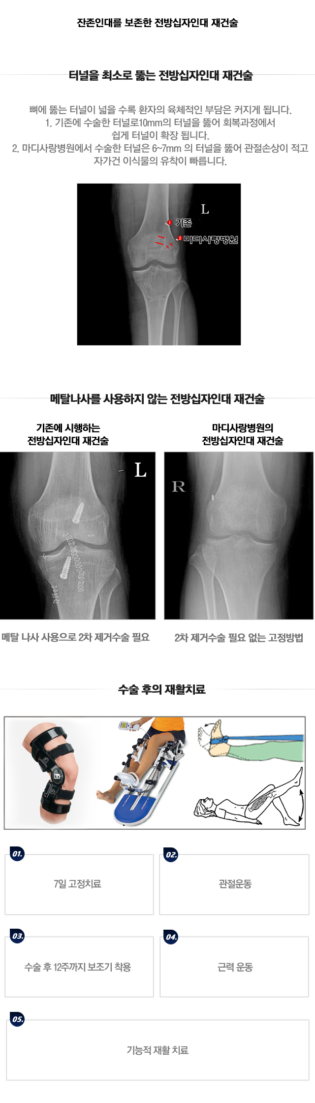 후방십자인대 재건술