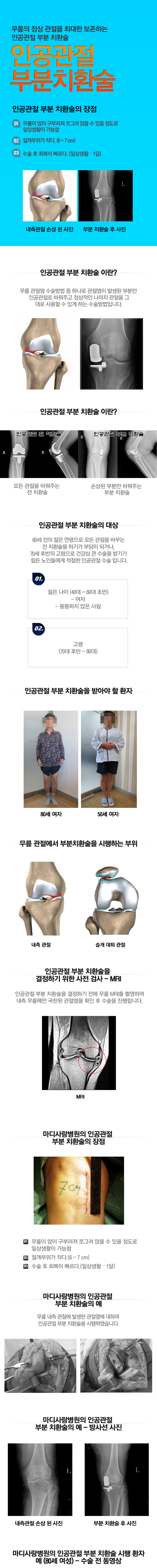 인공관절 전 치환술
