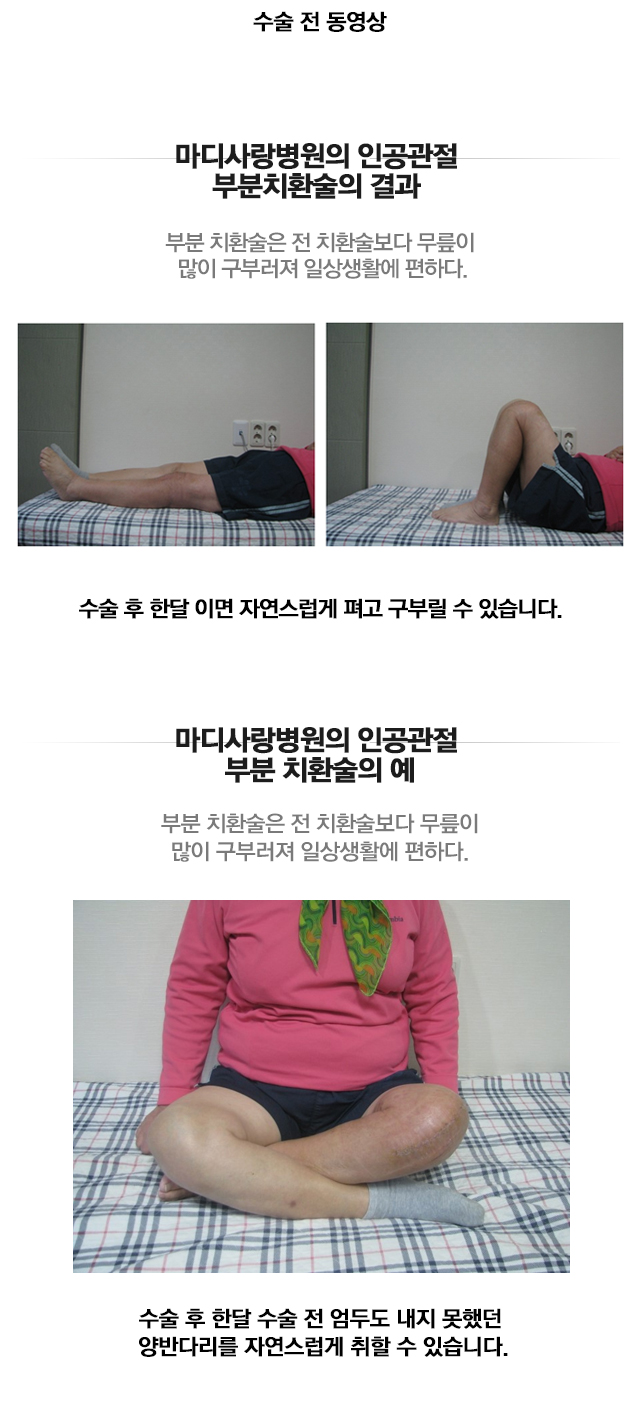 인공관절 전 치환술
