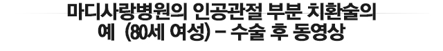 인공관절 전 치환술