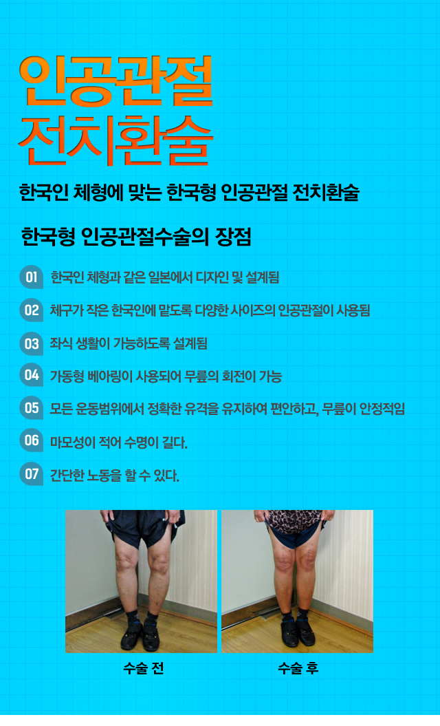 슬개대퇴관절 과압박 증후군