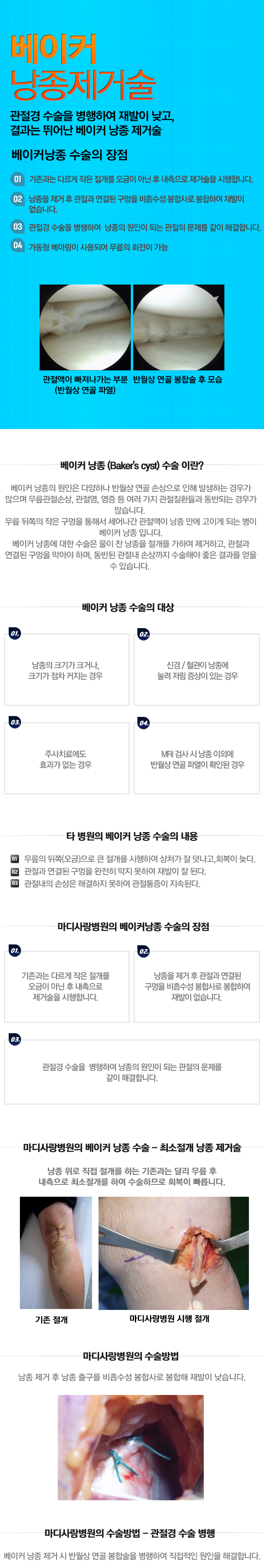 베이커 낭종수술
