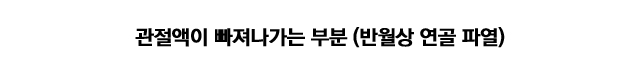 베이커 낭종수술