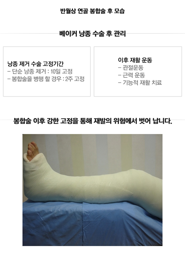 베이커 낭종수술