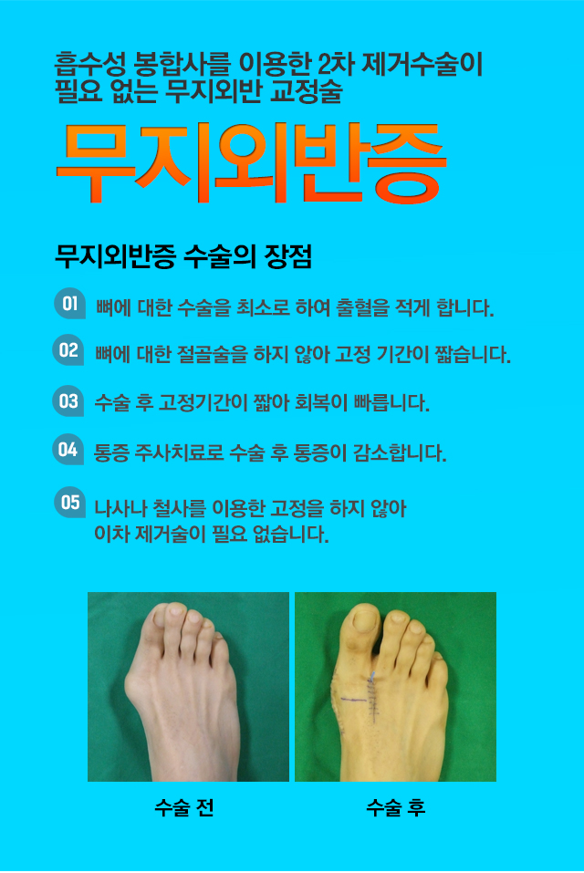 무지외반증