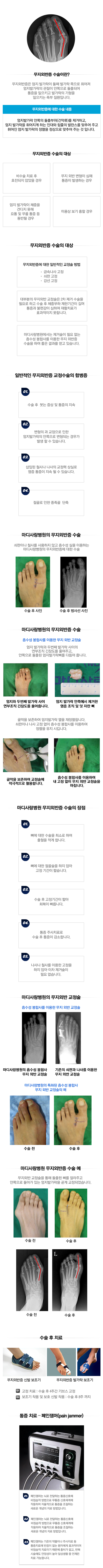 무지외반증