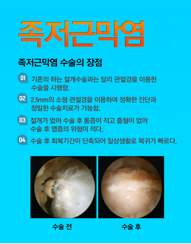 족저근막염