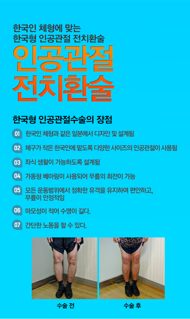 무릎 인공관절 전치환술