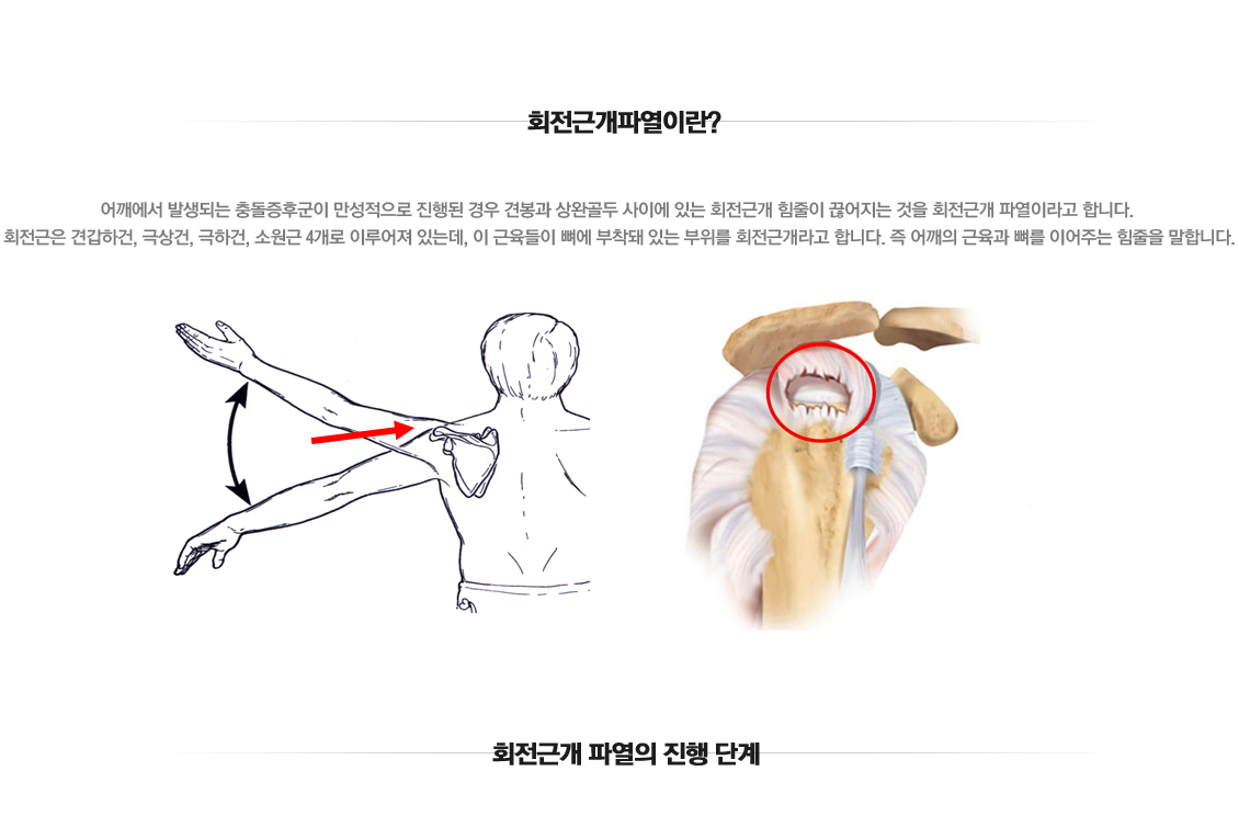 회전근개파열