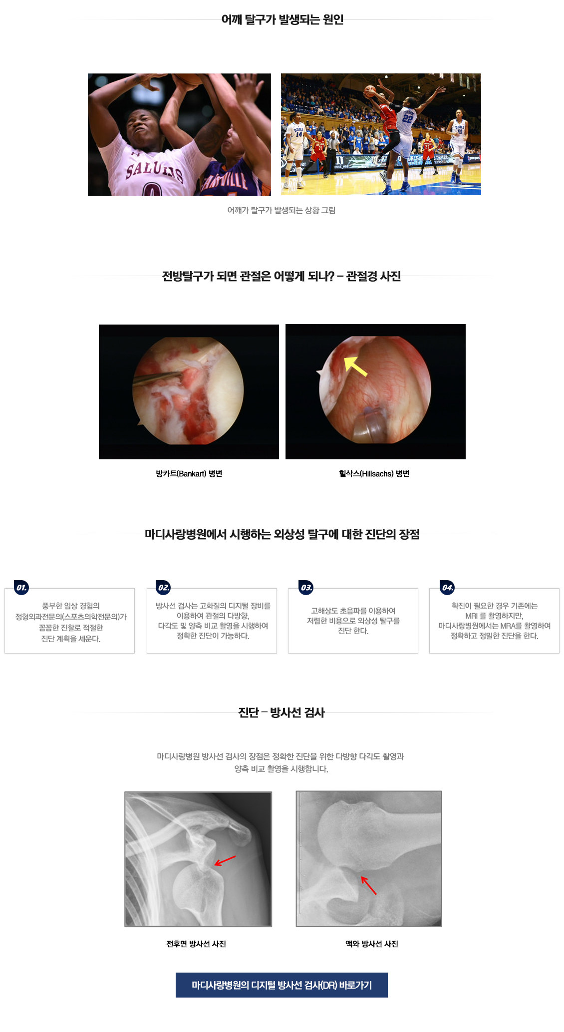 외상성 탈구