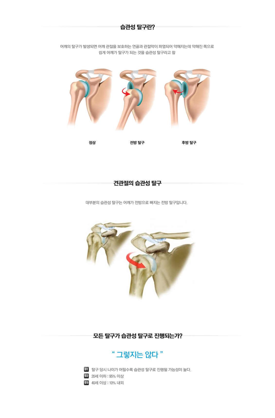 습관성 탈구