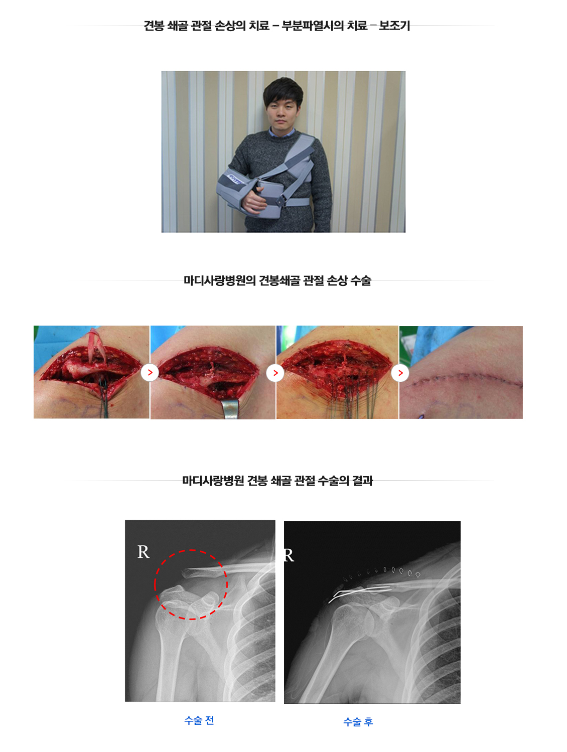 어깨관절의 외상