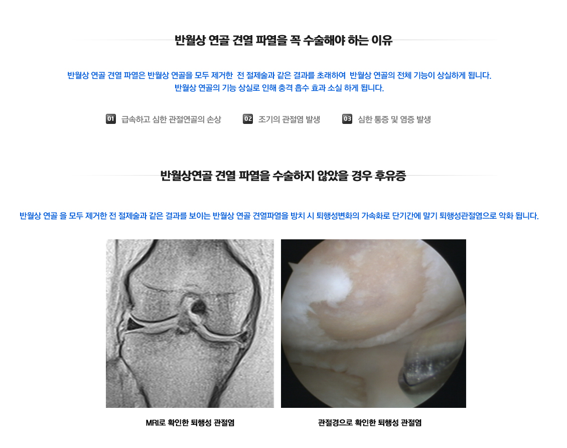 반월상연골 견열파열