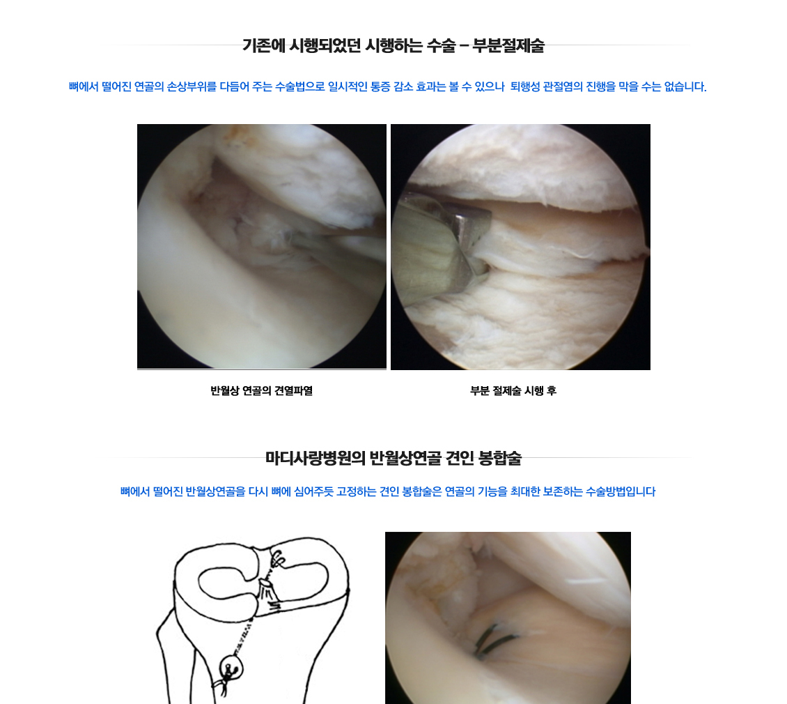 반월상연골 견열파열