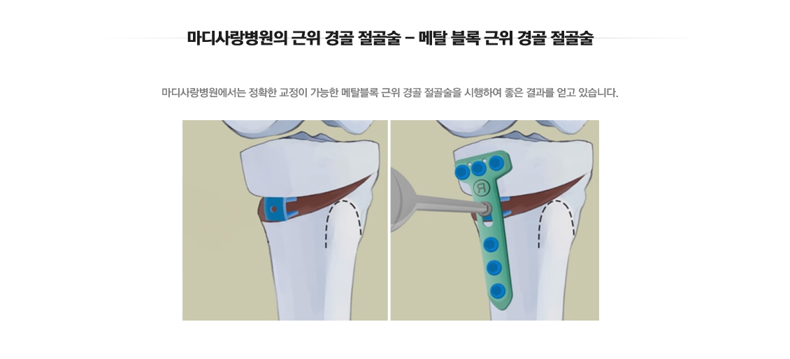 퇴행성관절염