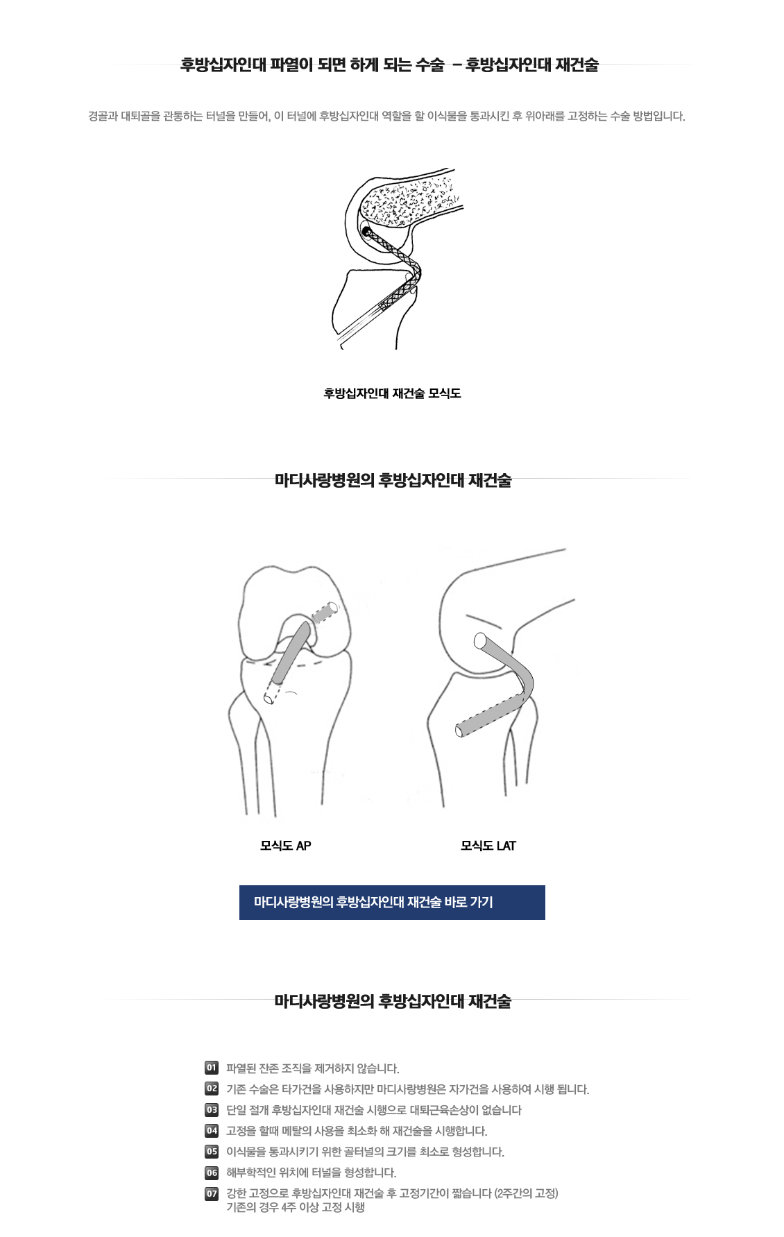 후방십자인대 파열