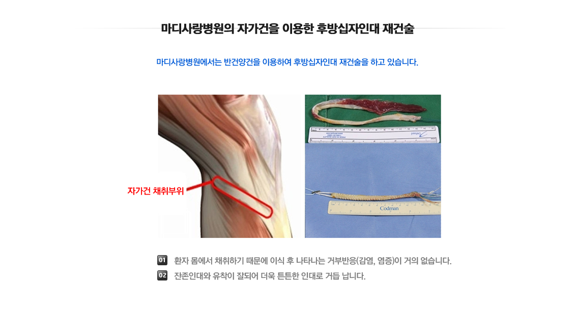 후방십자인대 파열