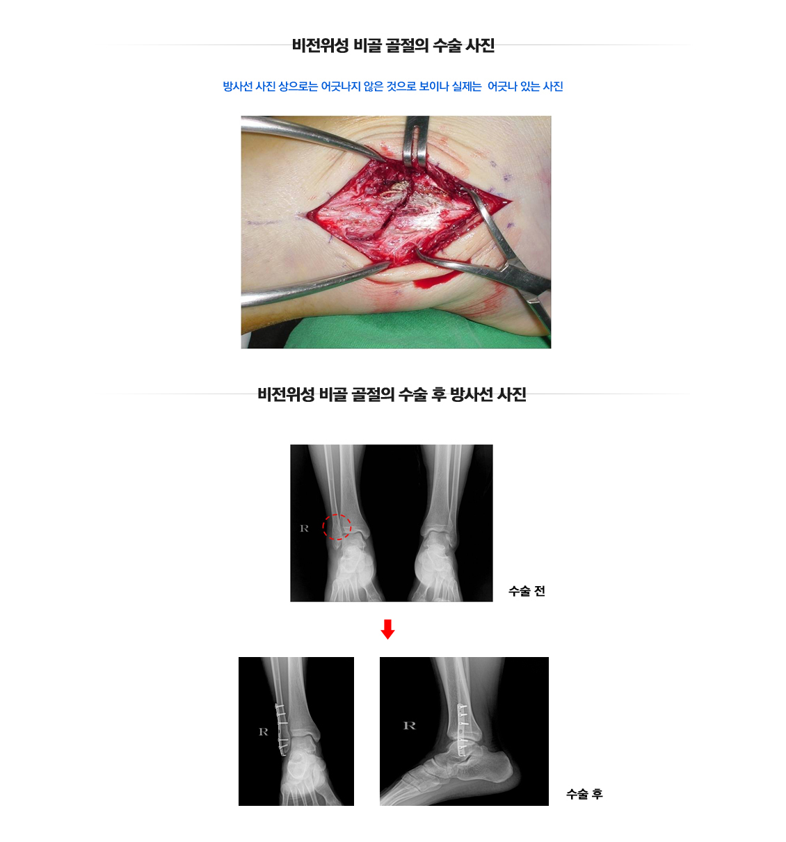 겨울철 골절