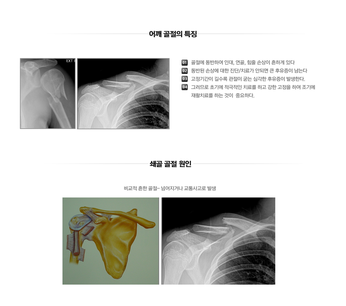 어깨 관절 골절