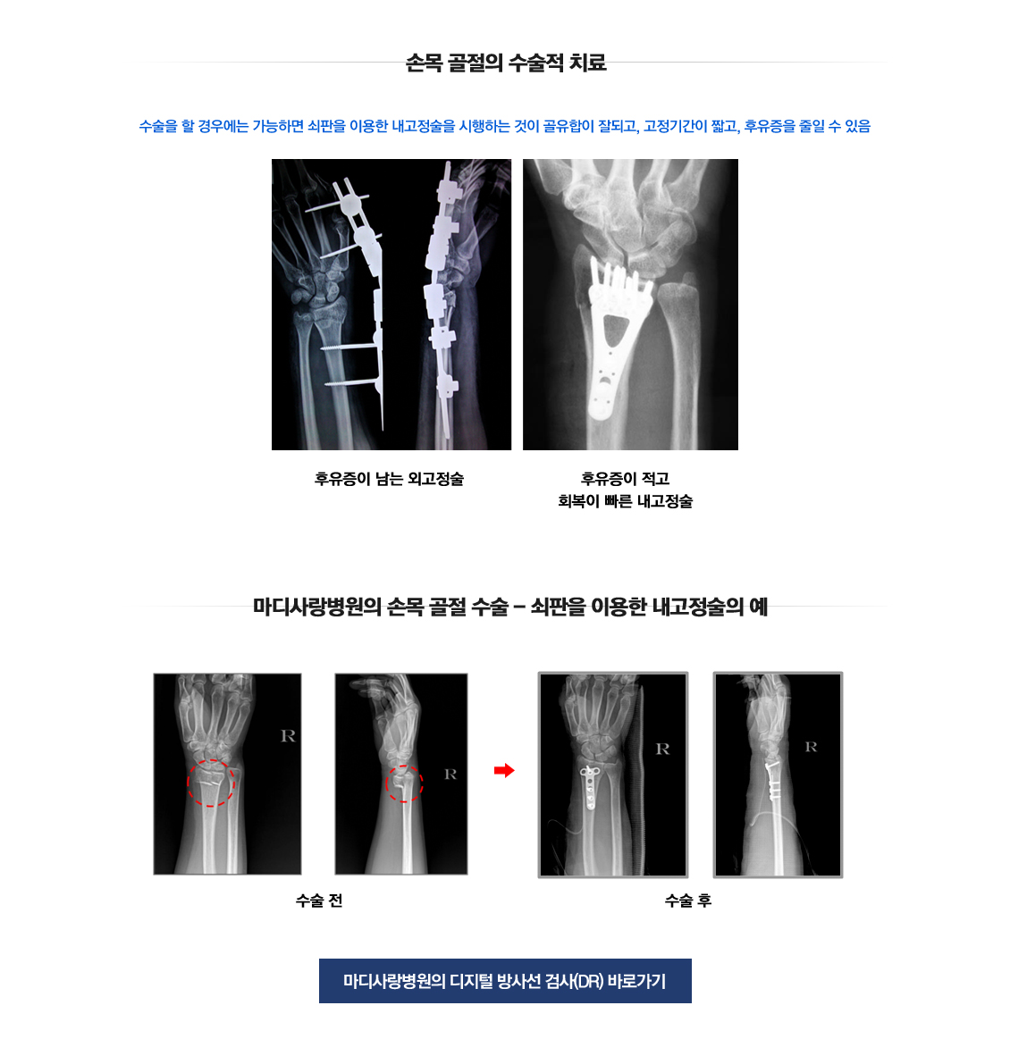 손목 관절 골절