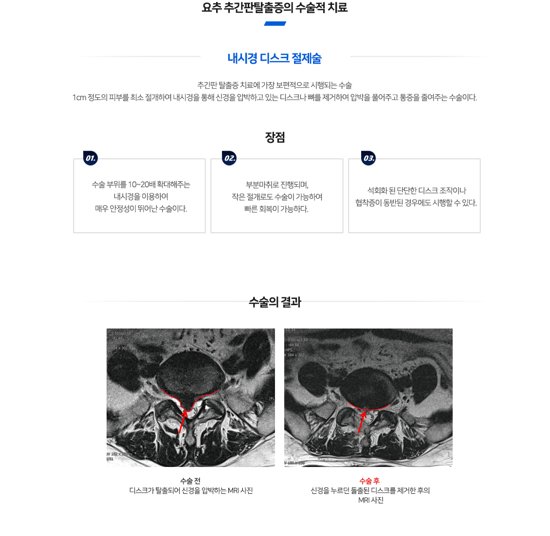 요추추간판탈출증