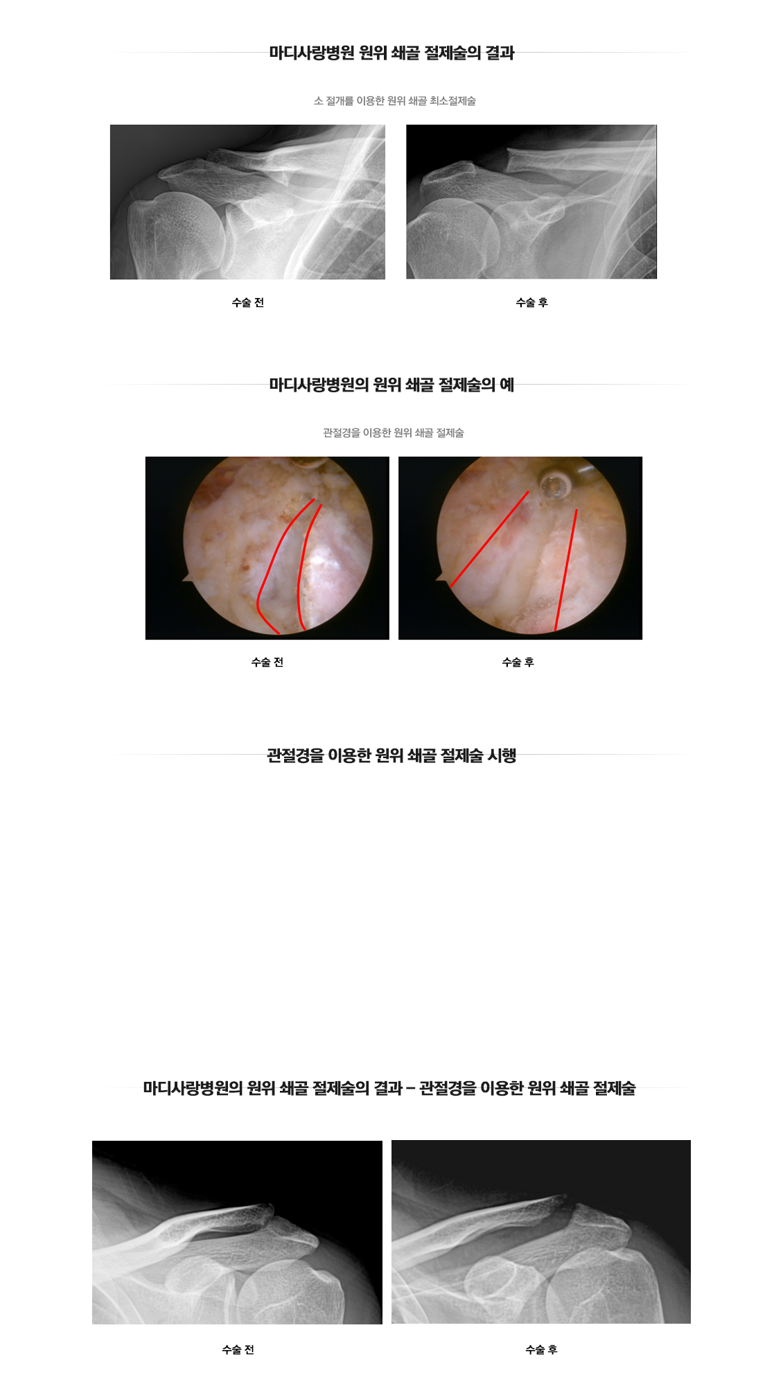 원위 쇄골 절제술