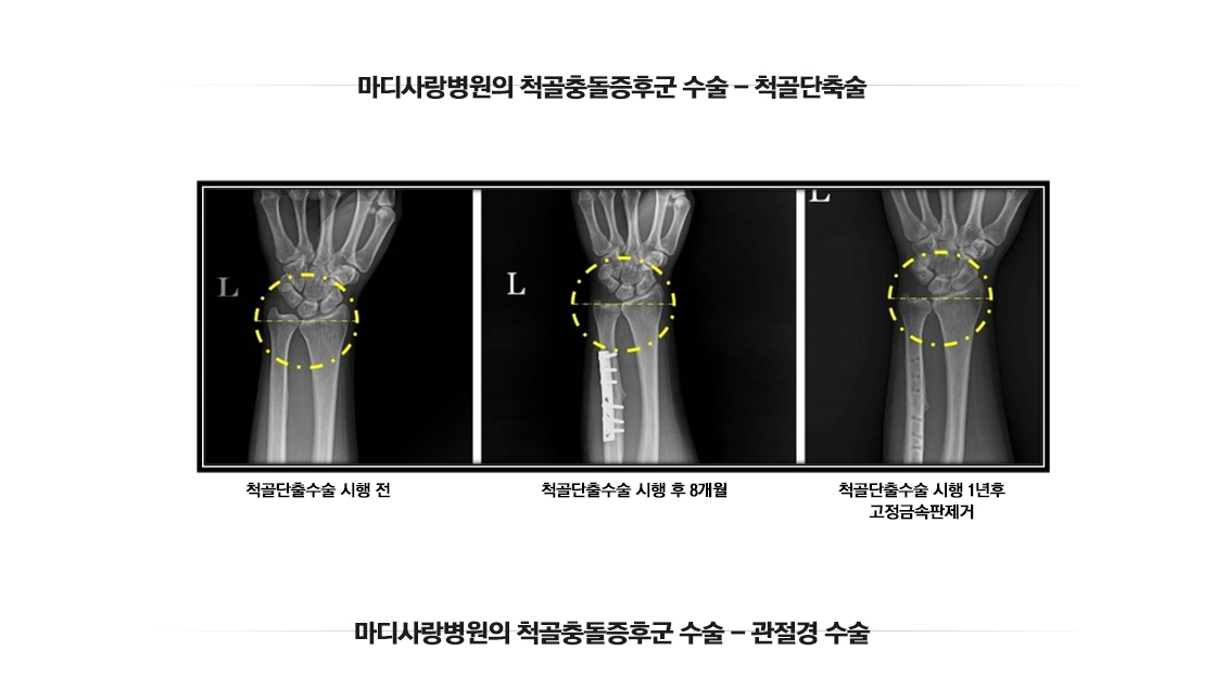 팔꿈치 골절수술