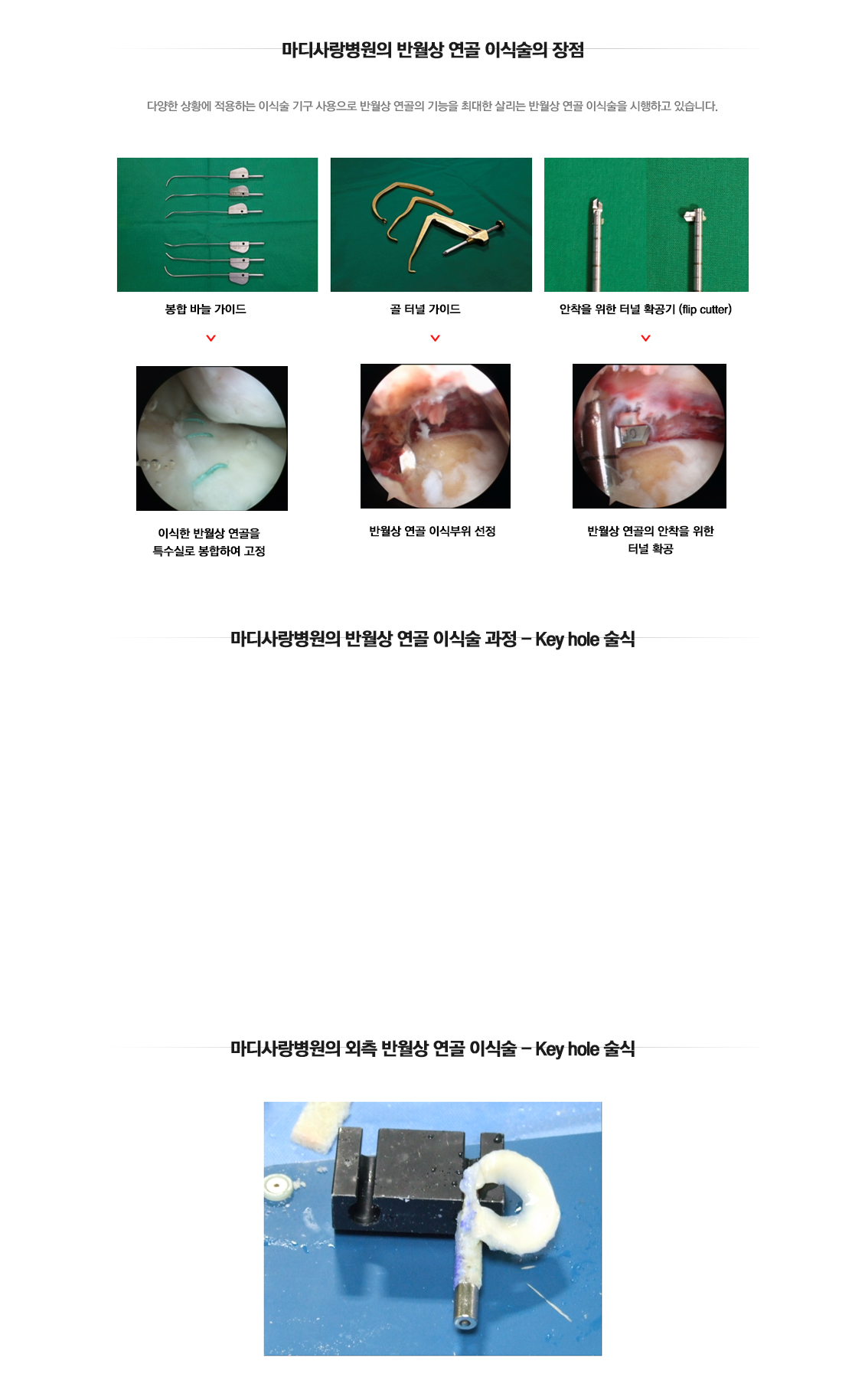 반월상연골 이식술