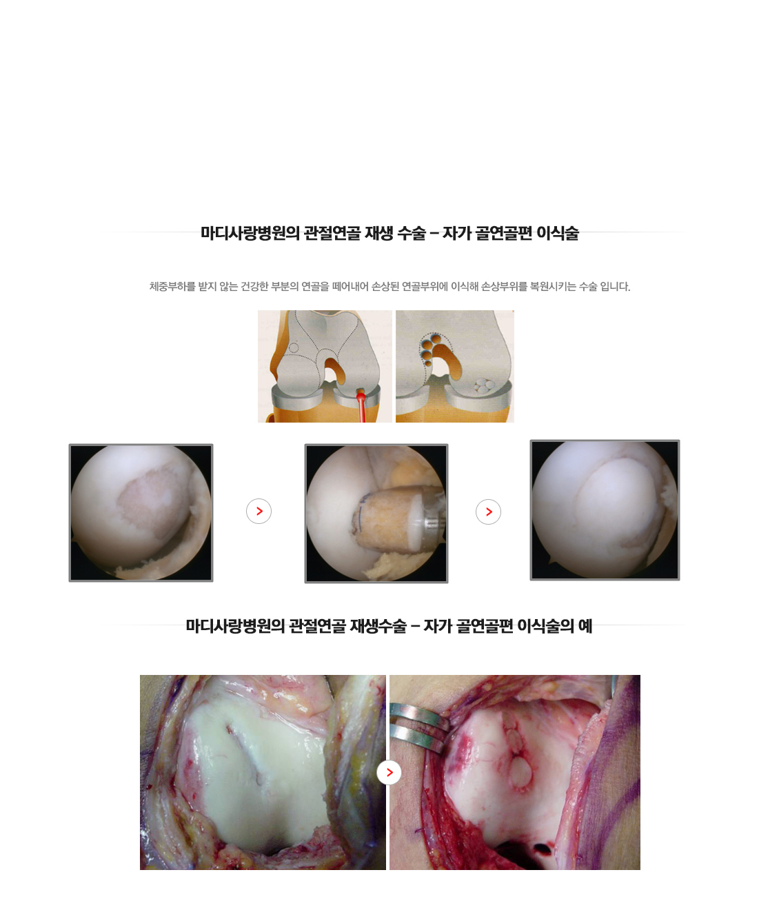 관절연골 재생 수술