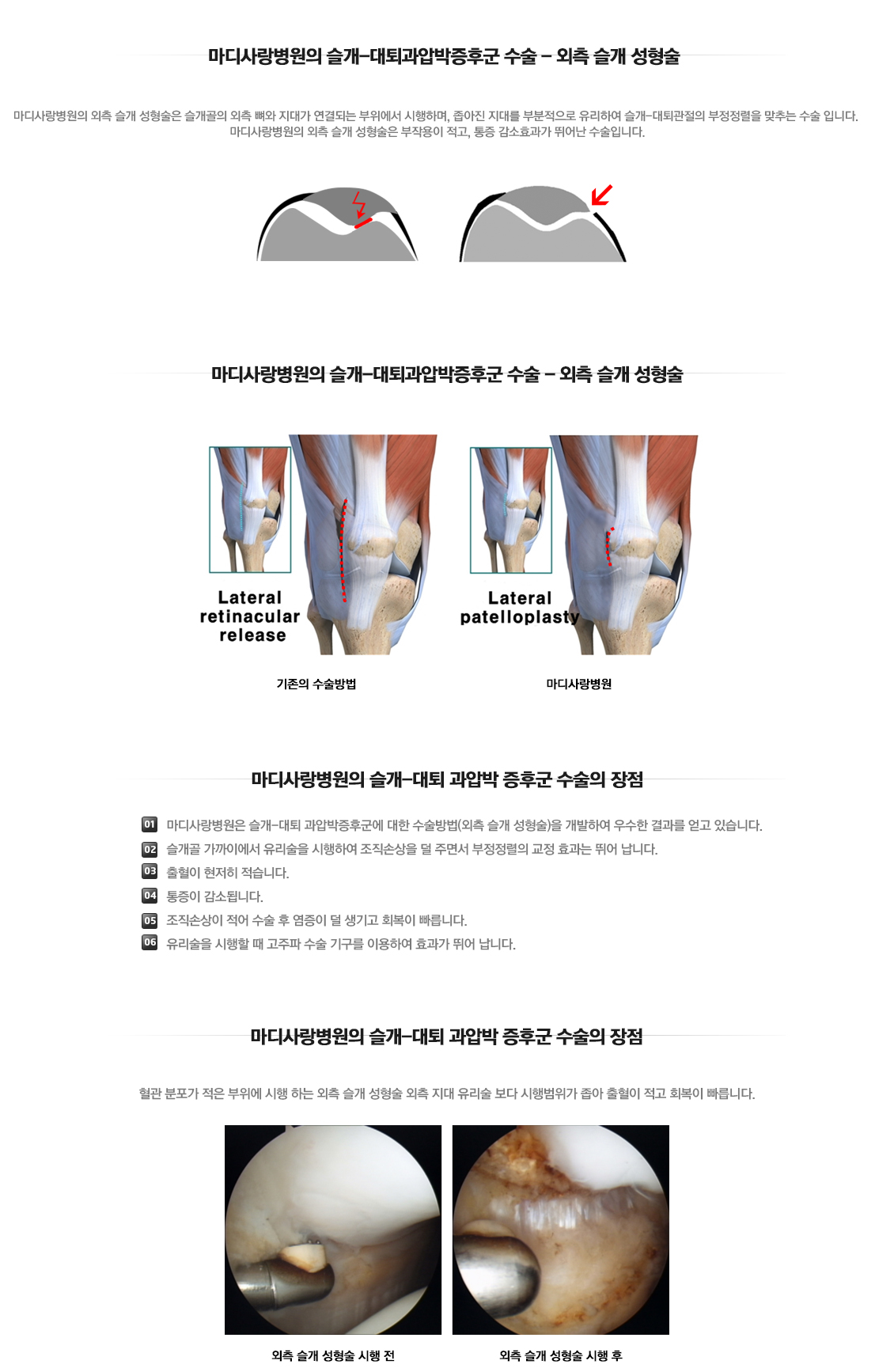 슬개대퇴관절 과압박 증후군