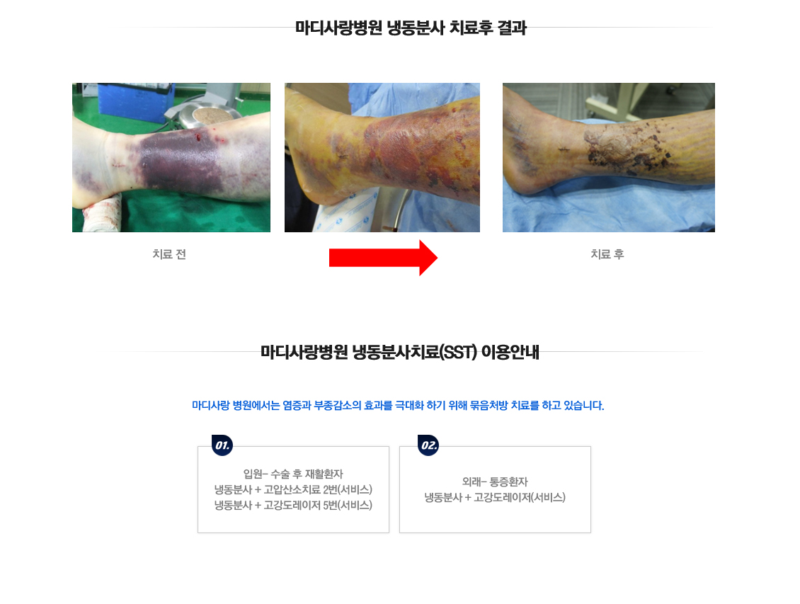 냉동분사치료(SST)